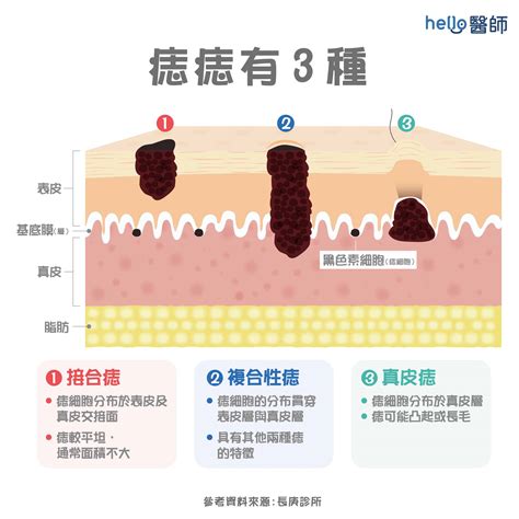 身上有痣|痣形成的原因？痣長毛、痣變多變大是痣病變？5招判別